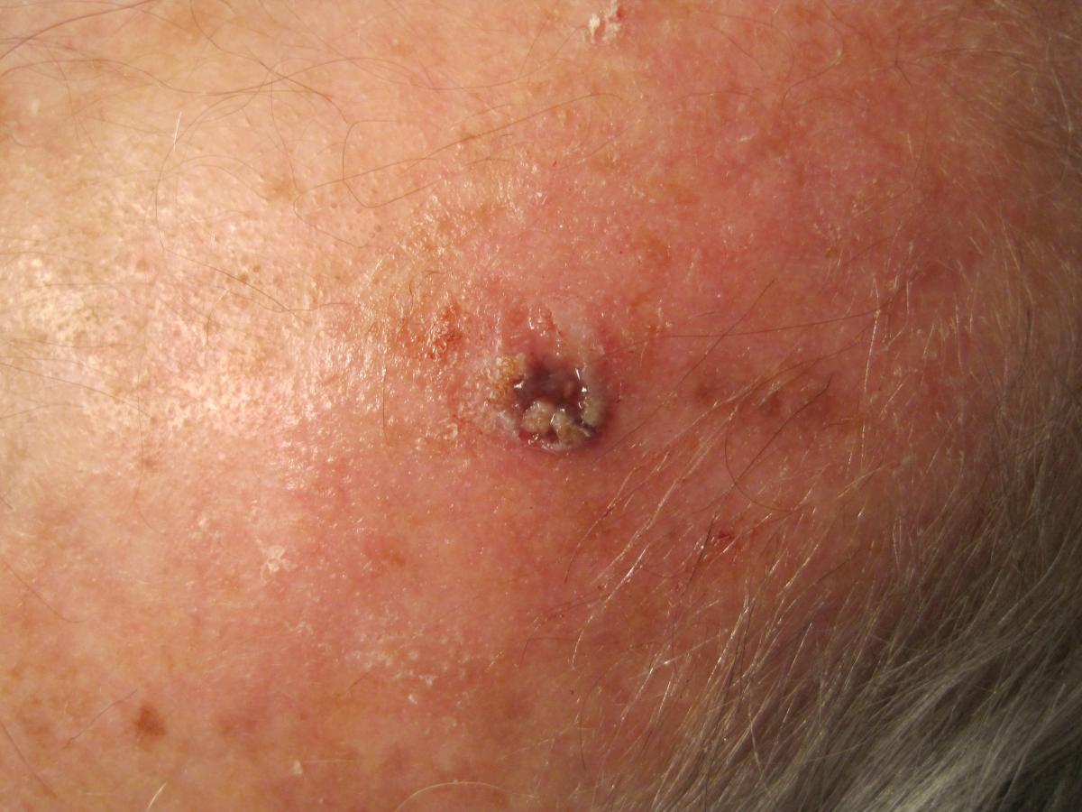 Actinic keratosis healing