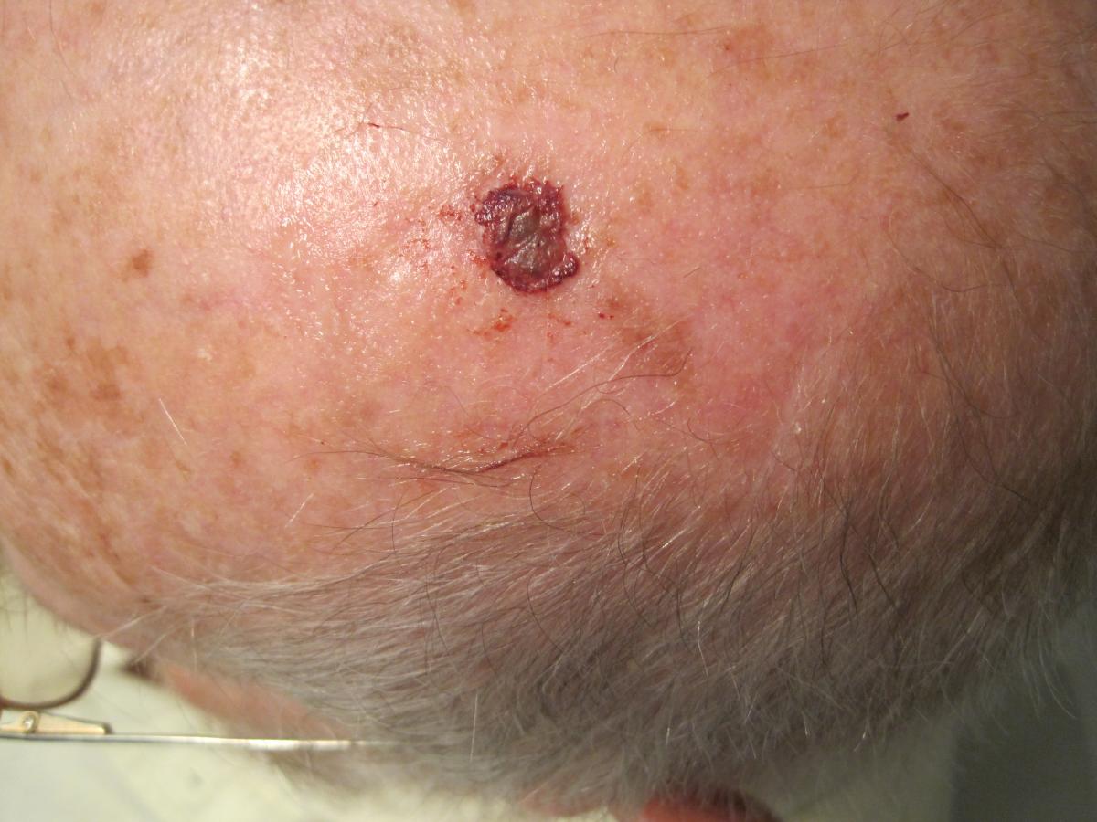 Actinic keratosis healing 2