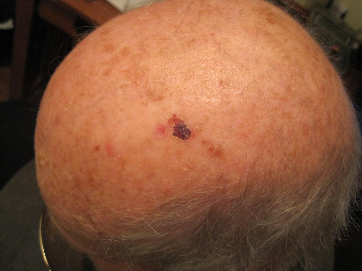 Actinic keratosis healing 3