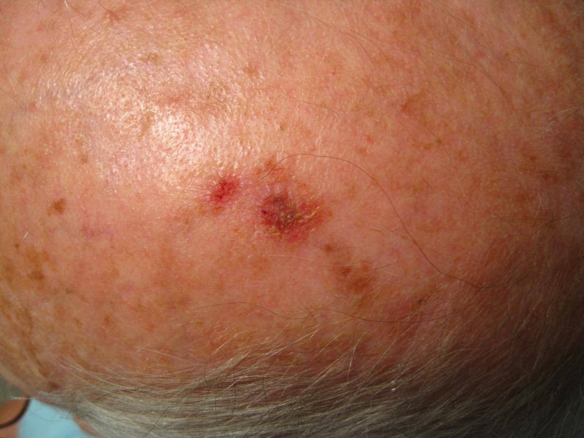 Actinic keratosis healing 4