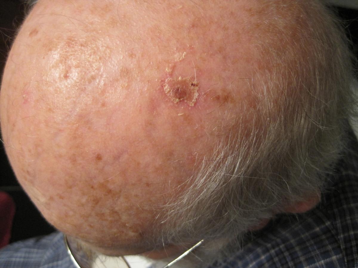 Actinic keratosis healing  5