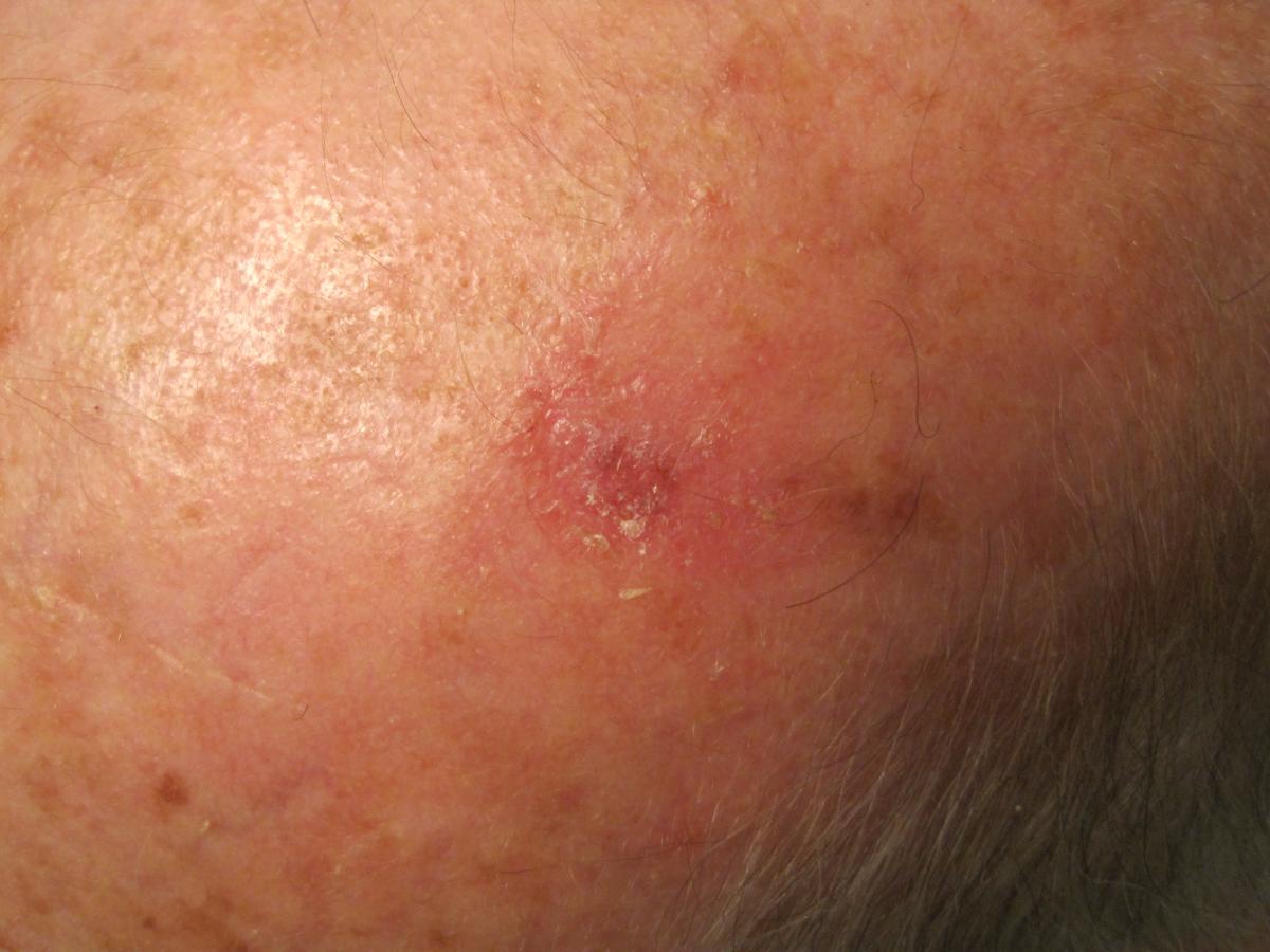 Actinic keratosis healing 5