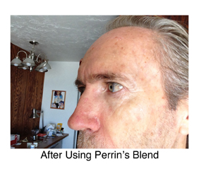 basal cell carconoma after Perrin's Blend natural treatment