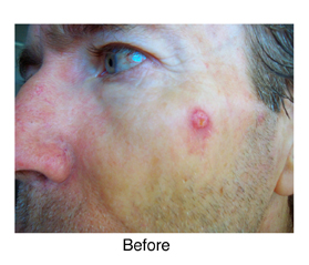 basal cell carconoma before Perrin's Blend natural treatment