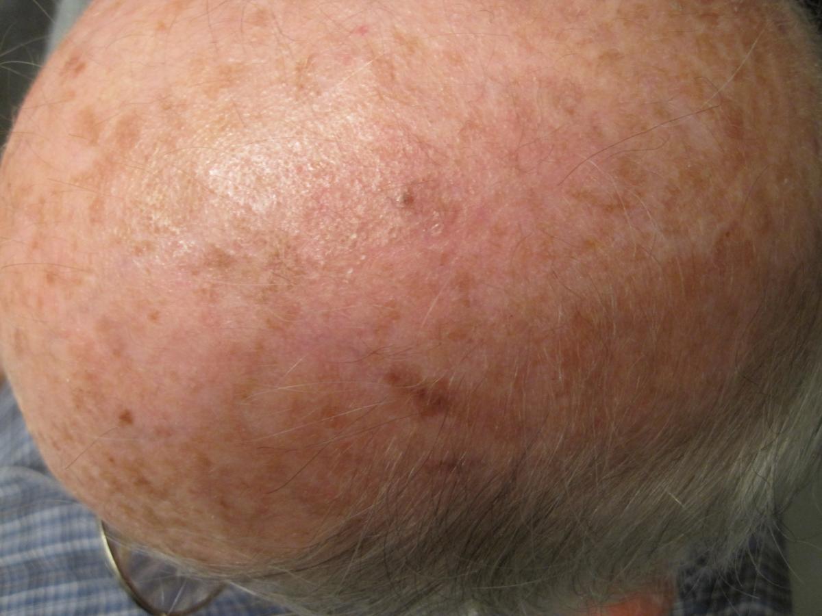 Actinic keratosis healed