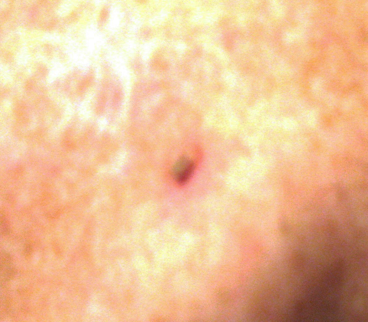 Basal Cell Carcinoma 