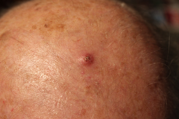 removing squamous cell carcinoma with perrin's blend 1