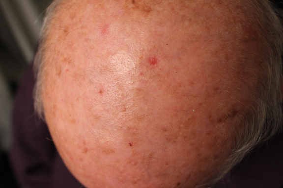 removing squamous cell carcinoma with perrin's blend 4