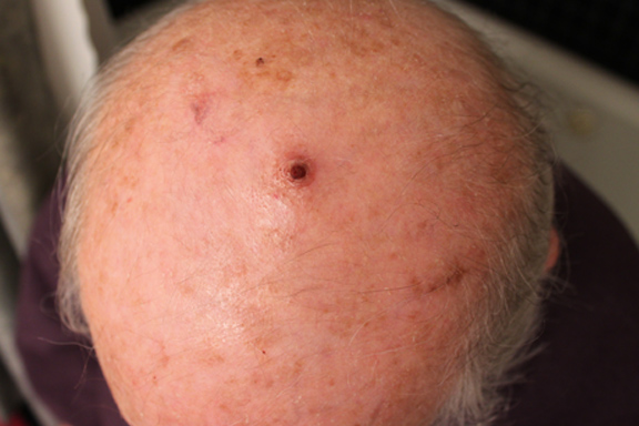 removing squamous cell carcinoma with perrin's blend 2