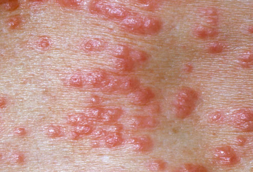 pictures of Scabies from WebMD.jpg