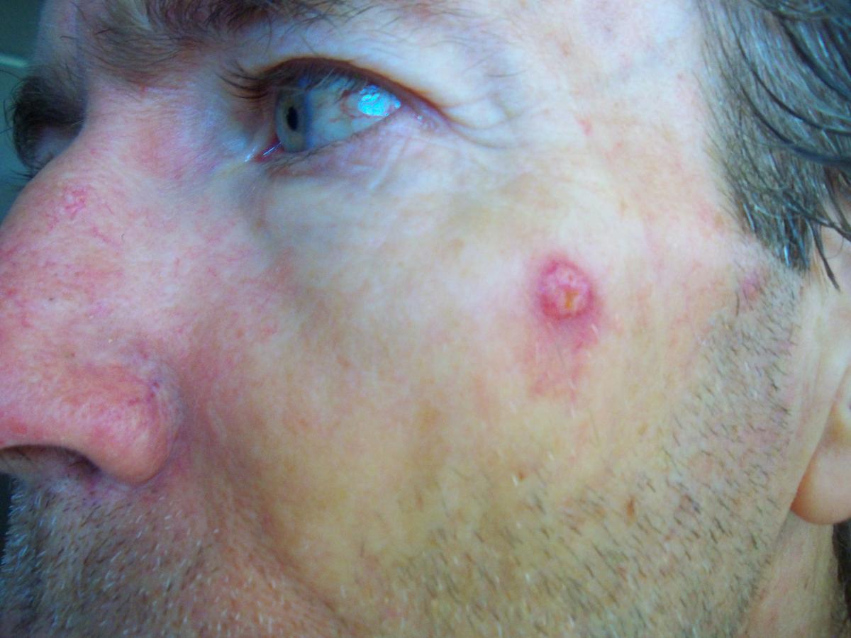 cyst on cheek