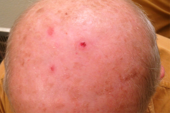 removing squamous cell carcinoma with perrin's blend 3