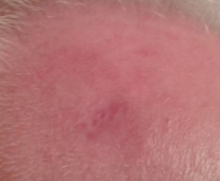 Seventeen Weeks After Using Perrin's Blend