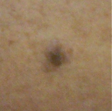 Before Treatment with Perrin's Blend