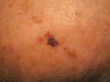 During Treatment with Perrin's Blend - Second photo - Taken three weeks later