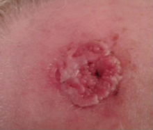 Four Weeks After Using Perrin's Blend