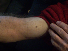 Before treatment with Perrin's Blend