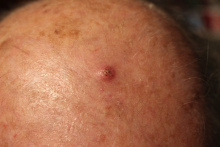 Lesion Before Using Perrin's Blend