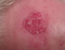 During Treatment 