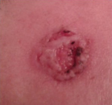 During Treatment 