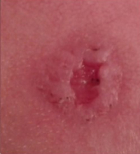 During Treatment 