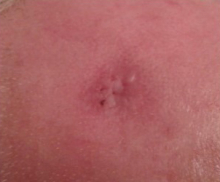 During Treatment 