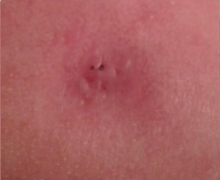 During Treatment 