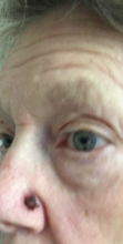 During Treatment 