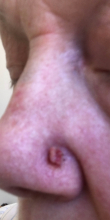 During Treatment 