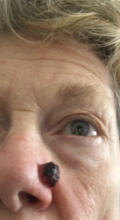 During Treatment