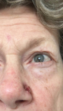 During Treatment 