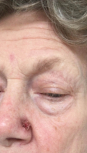 During Treatment 