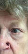 During Treatment 