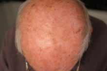 After Using Perrin's Blend