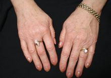 After Using Créme Complete for several months 