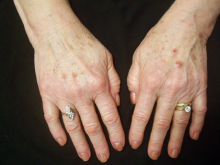 Sun Damage Spot Treatment