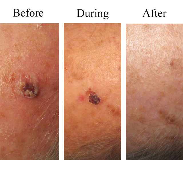 Before an After with Perrin's Blend